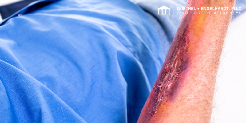 ann arbor burn injury attorney